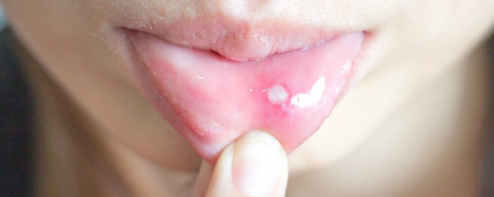 How to Prevent Mouth Sores