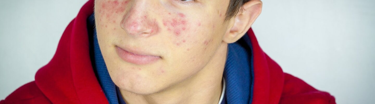 How to Prevent Pimples (Acne)