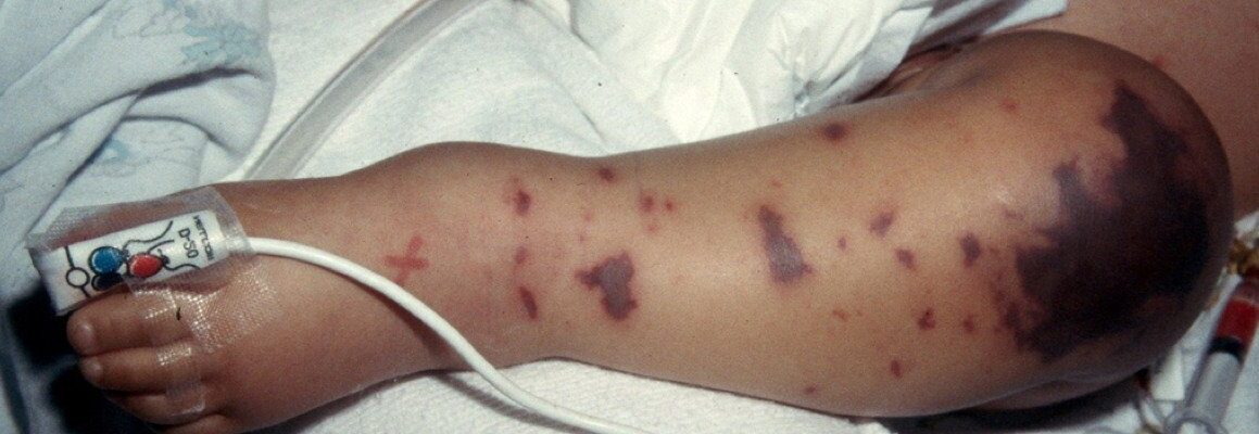 How to Prevent Meningococcemia
