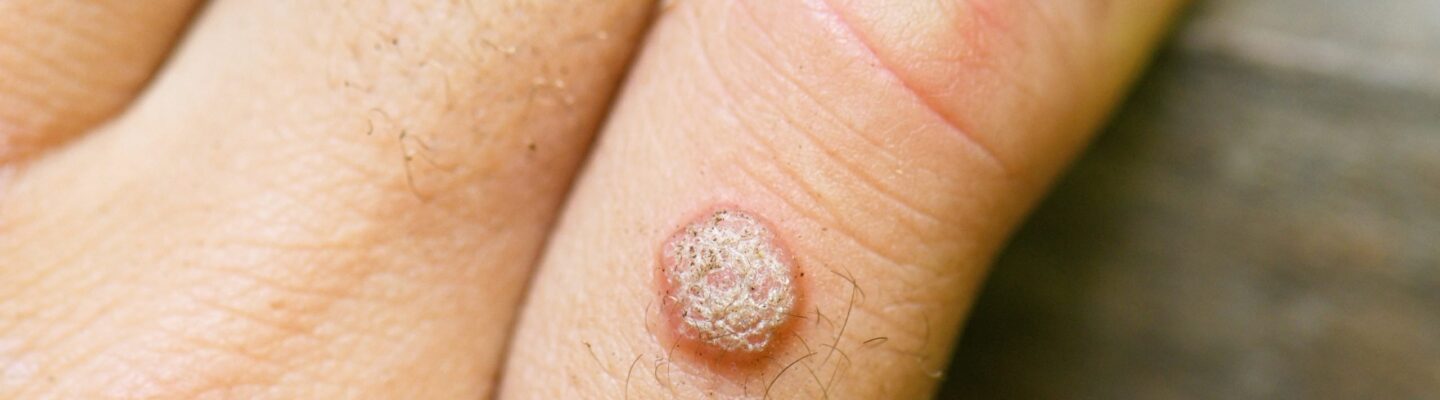 How to Prevent Warts