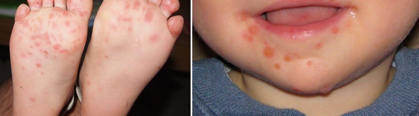 Hand, Foot and Mouth Disease