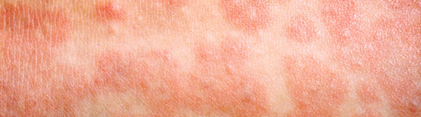 How to Identify Measles