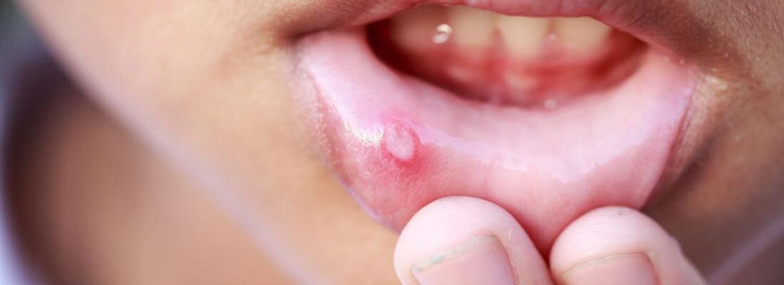 Mouth Sores