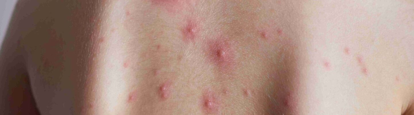 How to Prevent Chickenpox