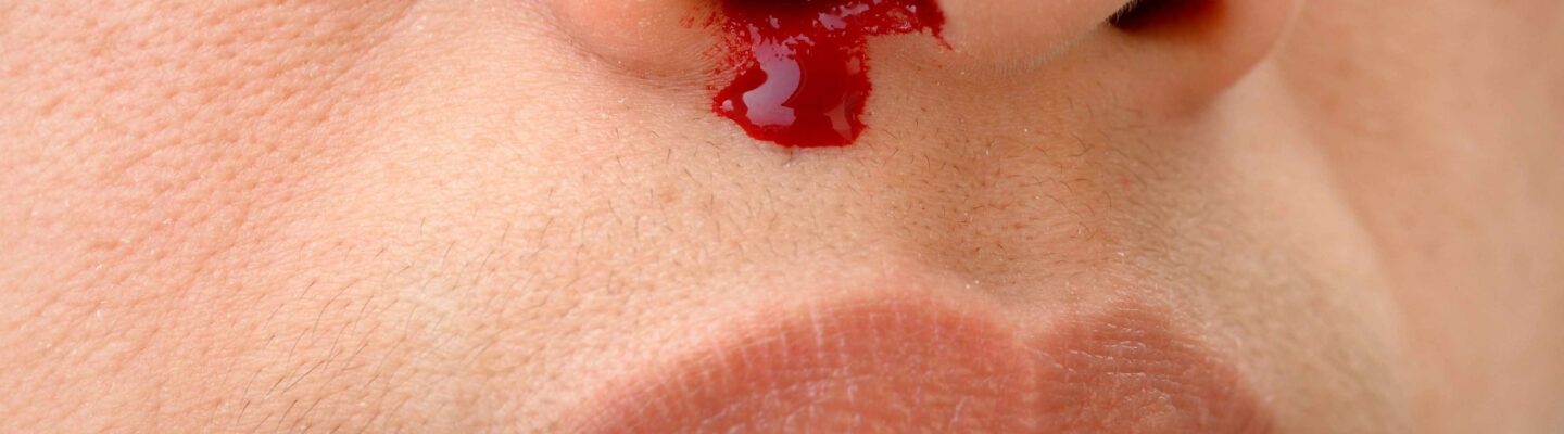 Nosebleed