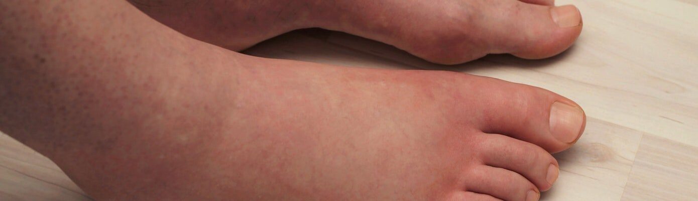 Swollen Feet: Is It Caused by High Uric Acid?