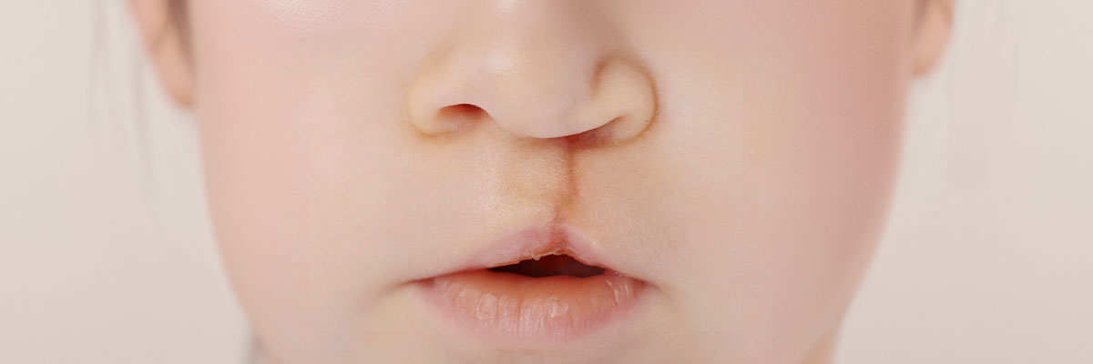 Cleft Lip and Palate