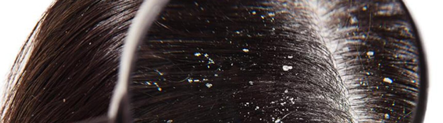 Dandruff