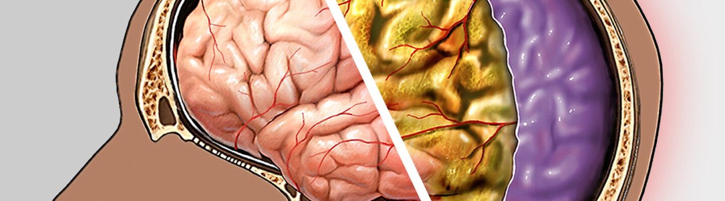 Meningitis