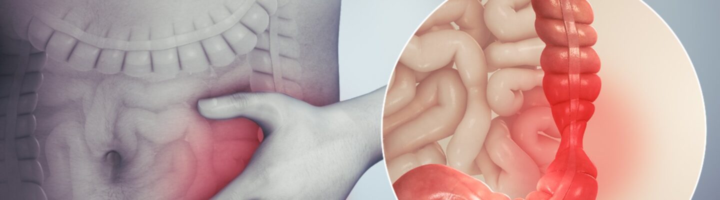 Irritable Bowel Syndrome