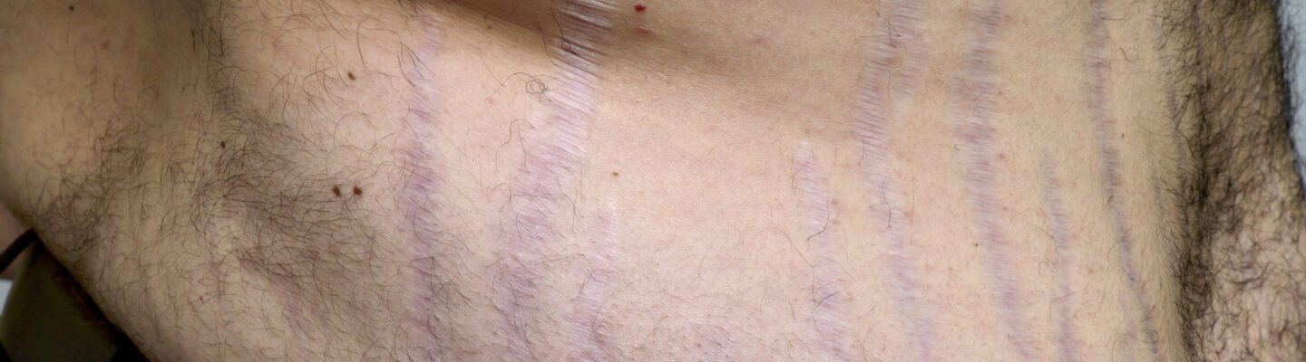 Cushing Syndrome