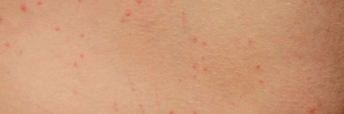 Bed Bug Bites
