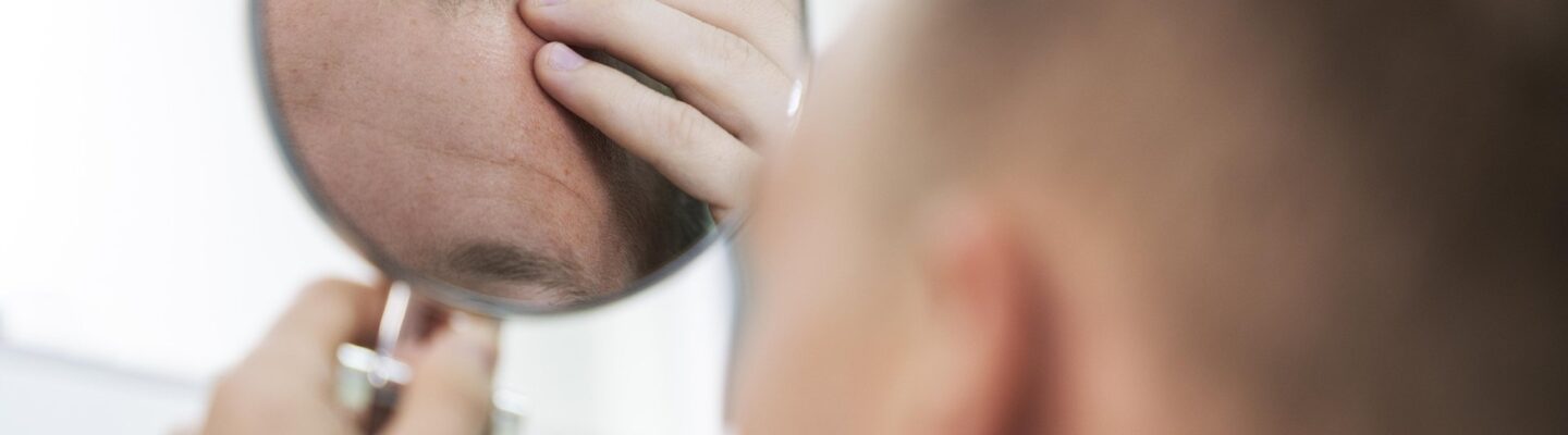Hair Loss in Men