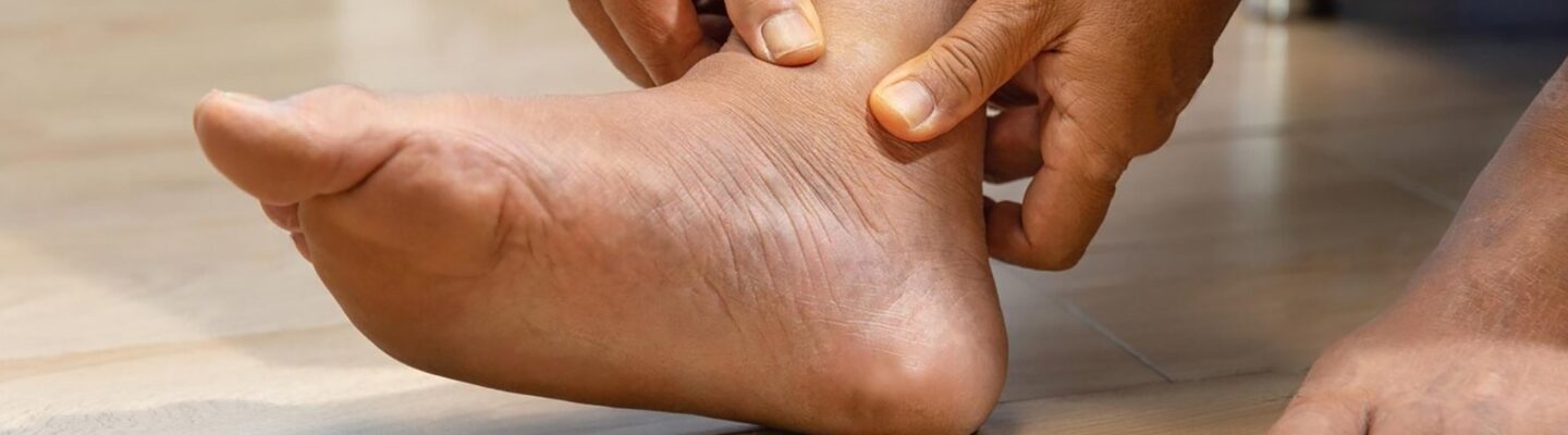 Swollen Feet